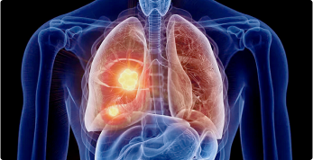Lung Cancer