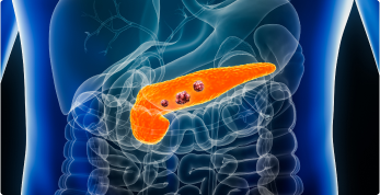 Pancreatic Cancer