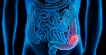 Colorectal Cancer