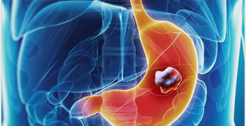 Stomach Cancer
